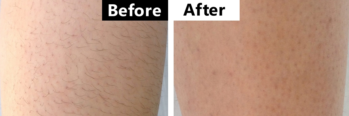 Before and after image of laser hair removal on a leg