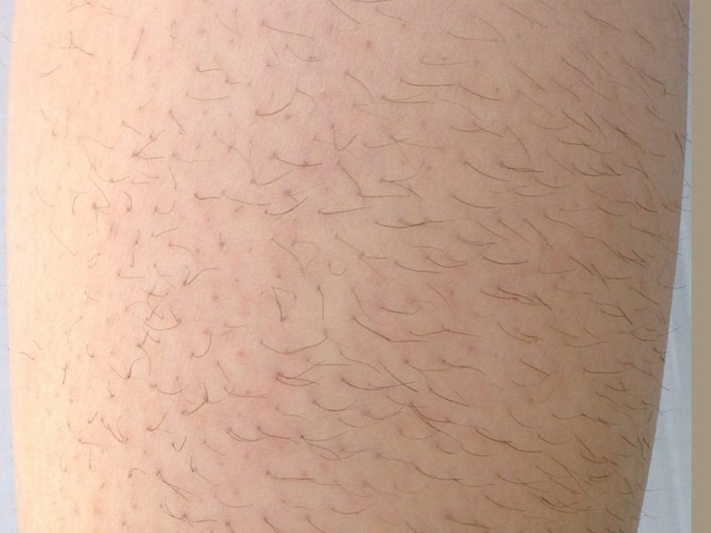 before a laser hair removal