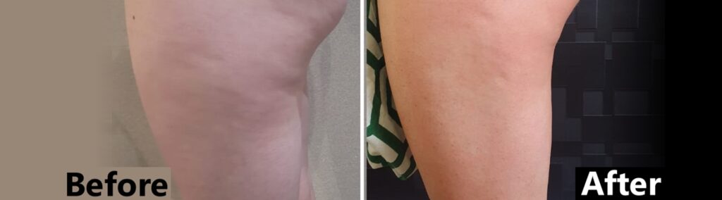 Cellulite on legs before and after T-shape contouring