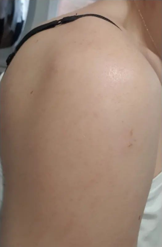 Arm after a chemical peel