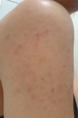 Arm before a chemical peel
