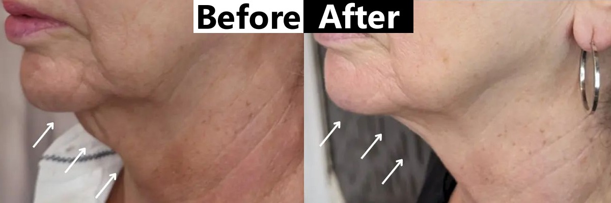 Jowls before and after Morpheus8 treatment