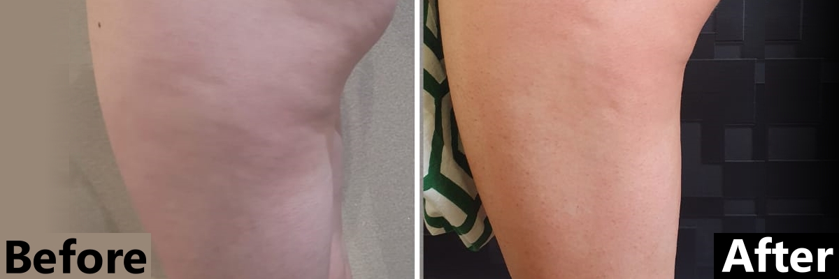 Cellulite on legs before and after T-shape contouring