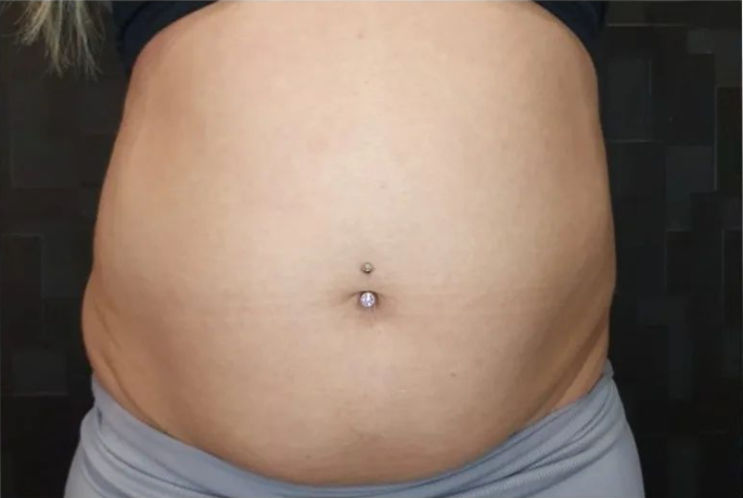 Stomach before T-Shape treatment