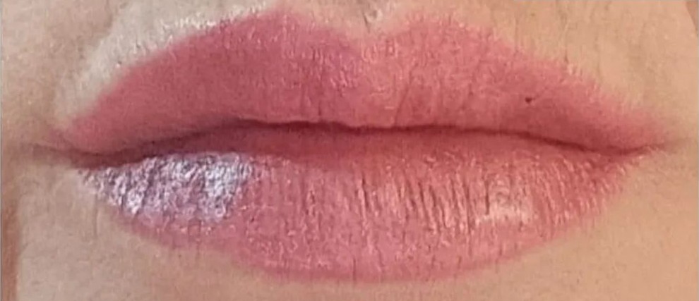 Lips after fillers