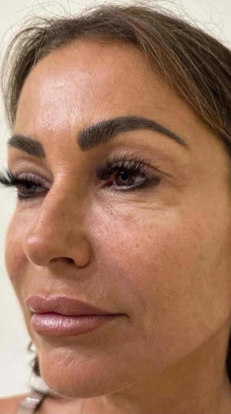 Woman's face before Polynucleotides treatment