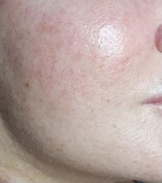Reduced acne on face after Dermapen treatment