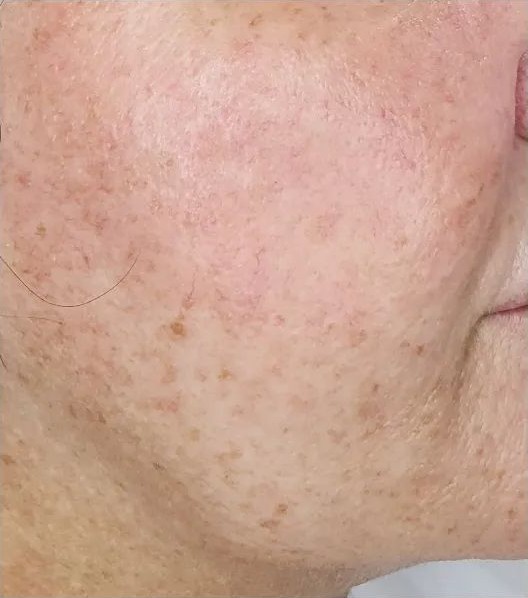 Acne on face before Dermapen treatment