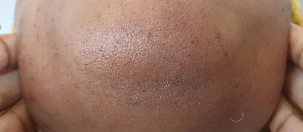 Balding head after hair removal