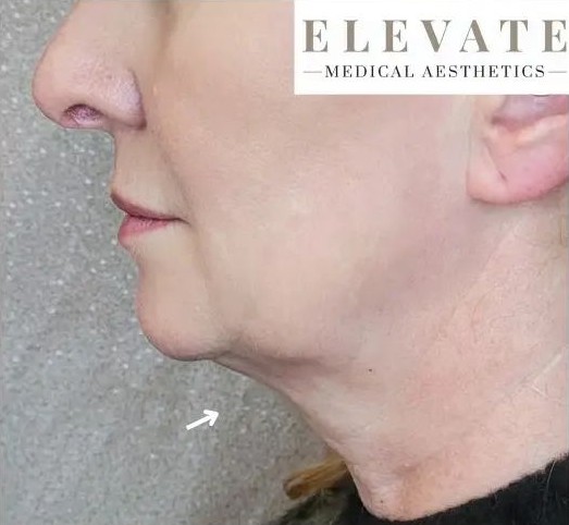 Jowls before Dermapen treatment