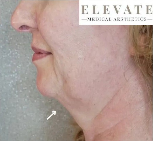 Jowls tightened after Dermapen treatment