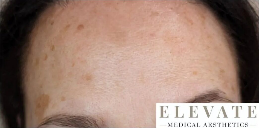 Forehead with spots before Lumecca treatment
