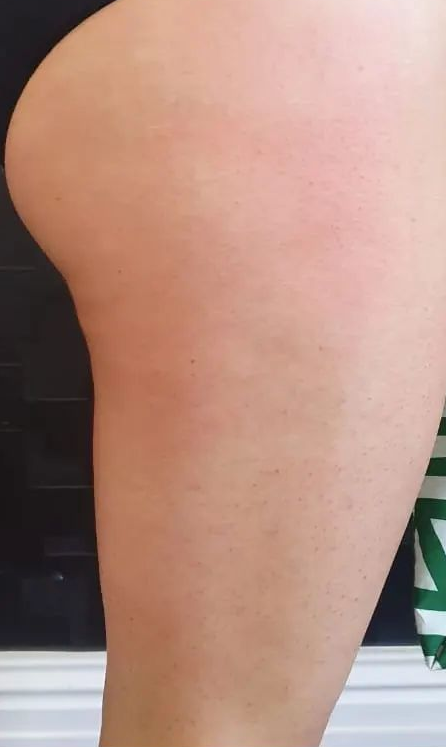 Reduced cellulite on leg after T-Shape treatment