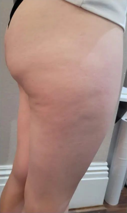 Cellulite on leg before T-Shape treatment