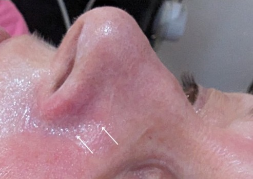 Reduced spider veins on the nose after treatment