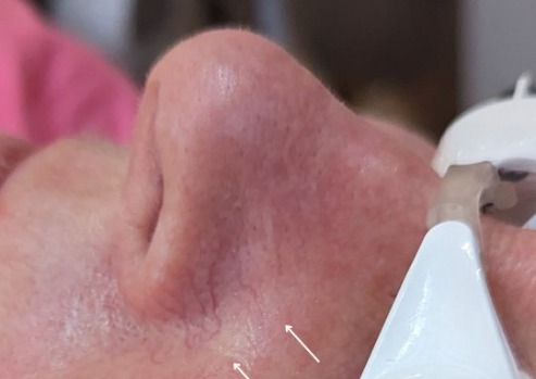 Spider veins on the nose before treatment