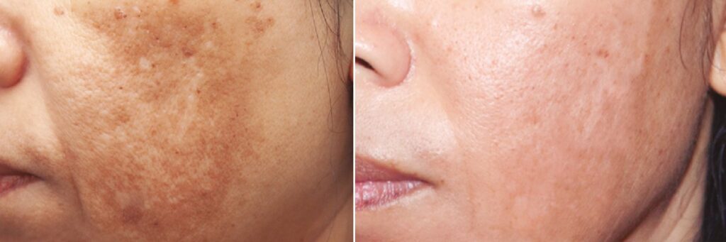 Face before and after a cosmelan peel
