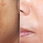 Face before and after a cosmelan peel