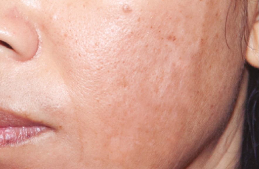 Face with reduced pigmentation after cosmelan treatment